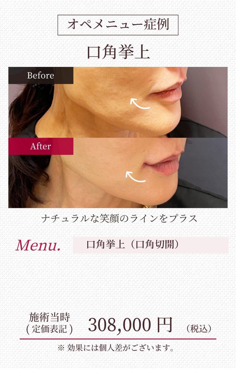 施工イメージ 11